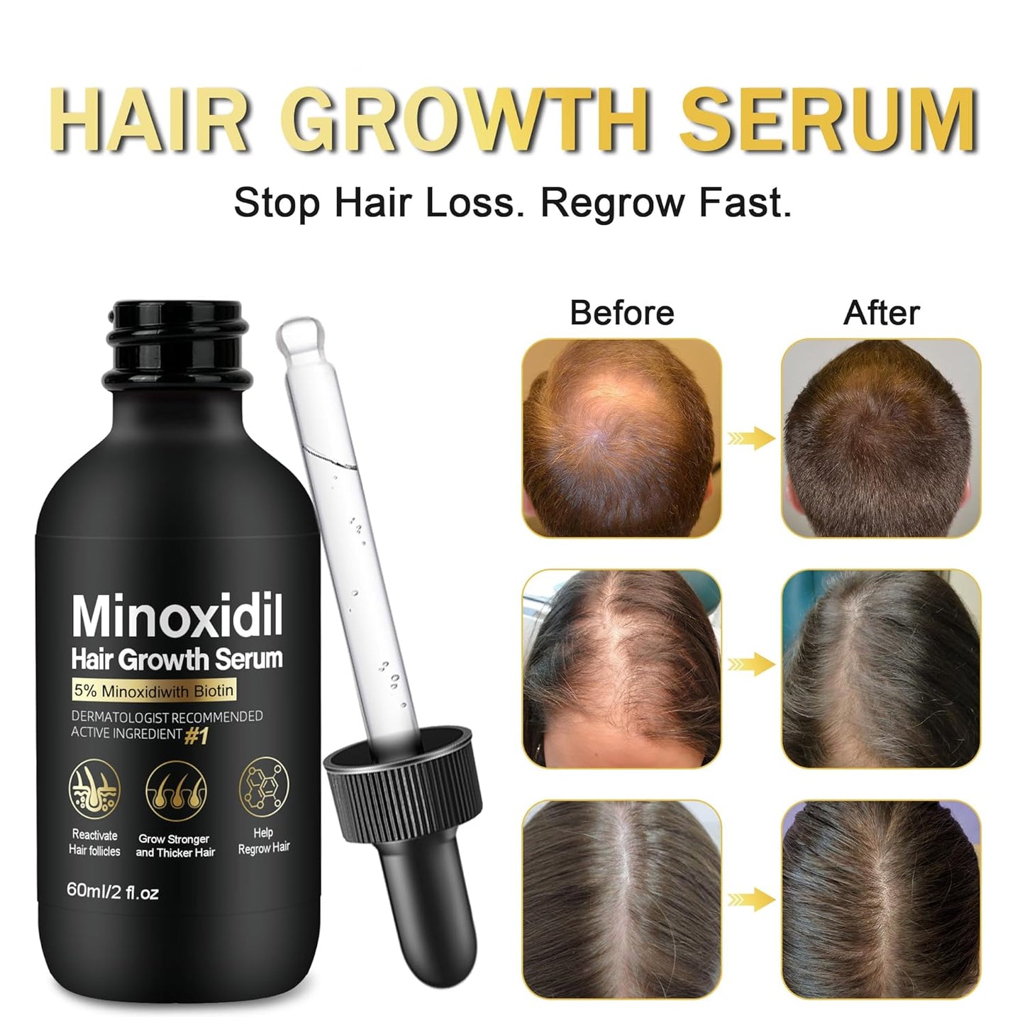 5% Minoxidil for Men and Women Hair Growth Treatment,Topical Minoxidil for Beard Growth, Hair Regrowth Serum for Scalp Hair Loss and Thinning, with Biotin (3Pack)